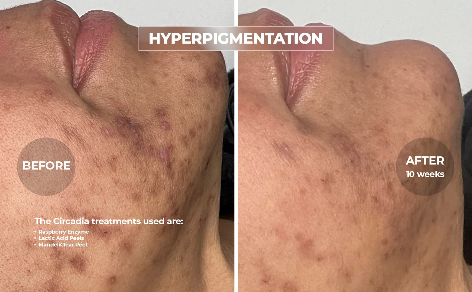 Circadia clinical before and after for Hyperpigmentation, using Raspberry Enzyme · Lactic Acid · MandeliClear Peel, over 10 weeks