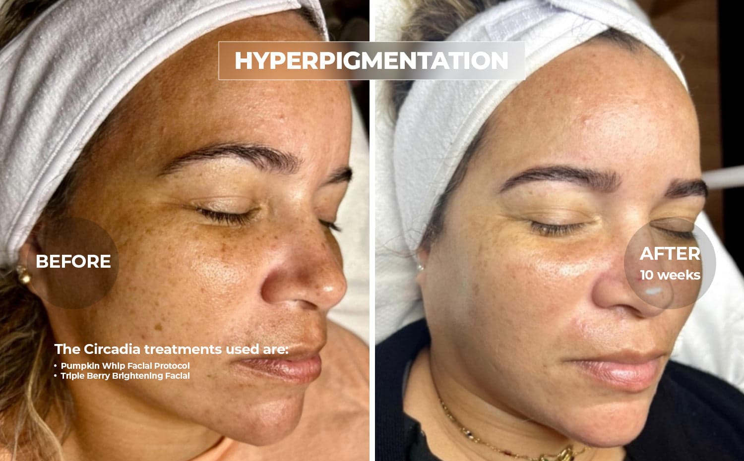 Circadia clinical before and after for Pigmentation & Melasma, using Pumpkin Whip · Triple Berry Brightening, over 10 weeks