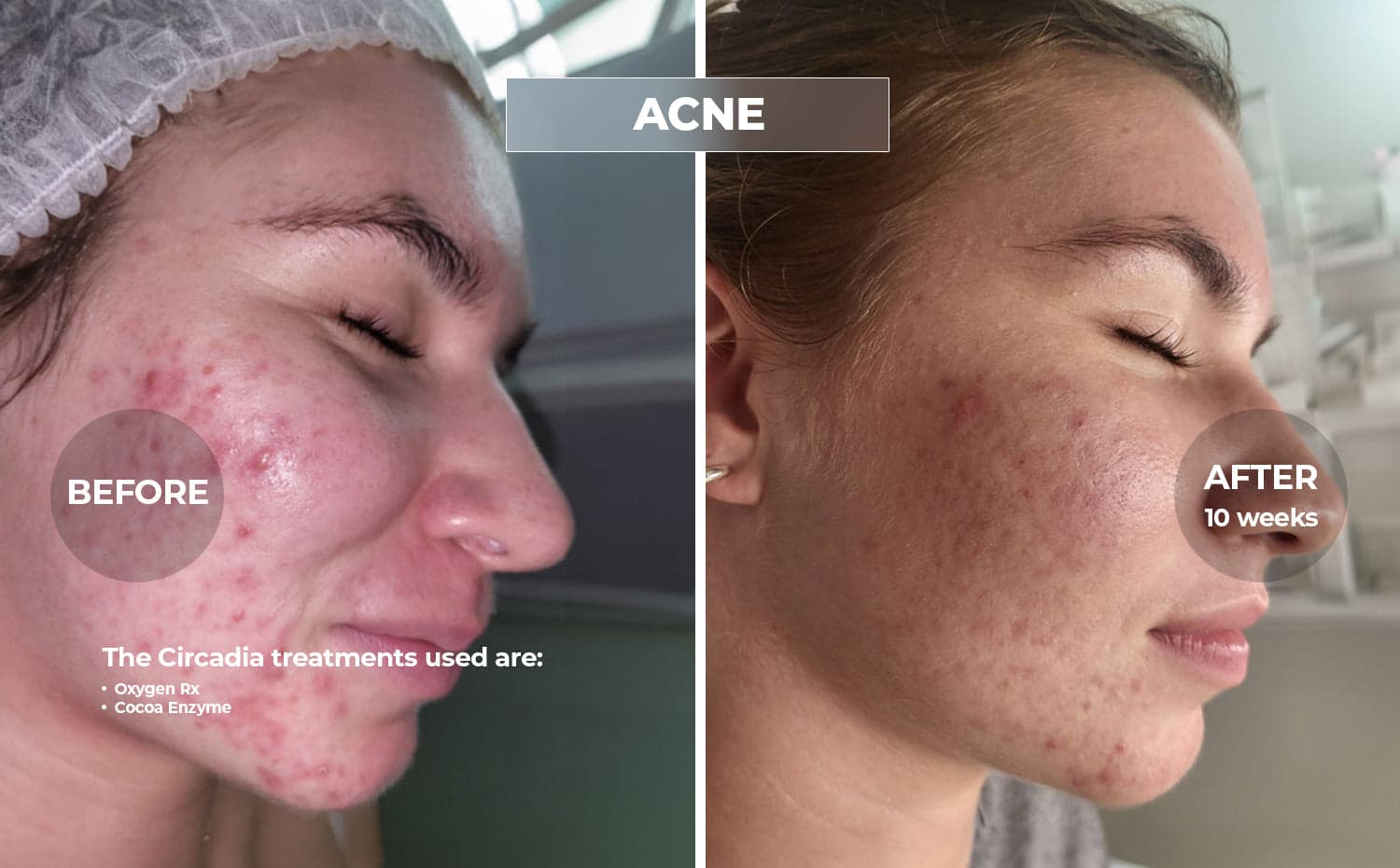 Circadia clinical before and after for Acne, using Oxygen Rx · Cocoa Enzyme, over 10 weeks