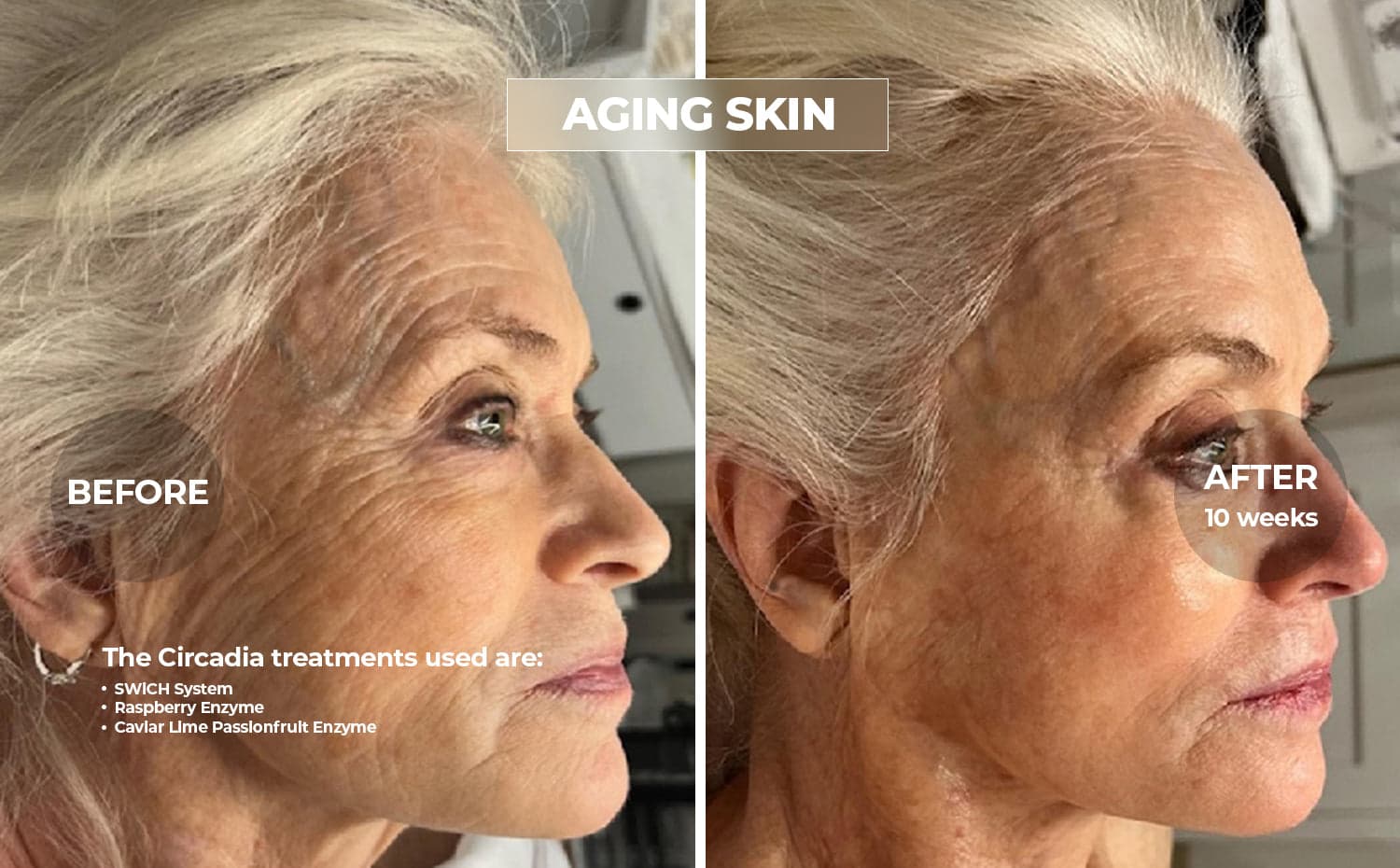 Circadia clinical before and after for Aging Skin, using SWiCH System · Raspberry Enzyme, over 10 weeks