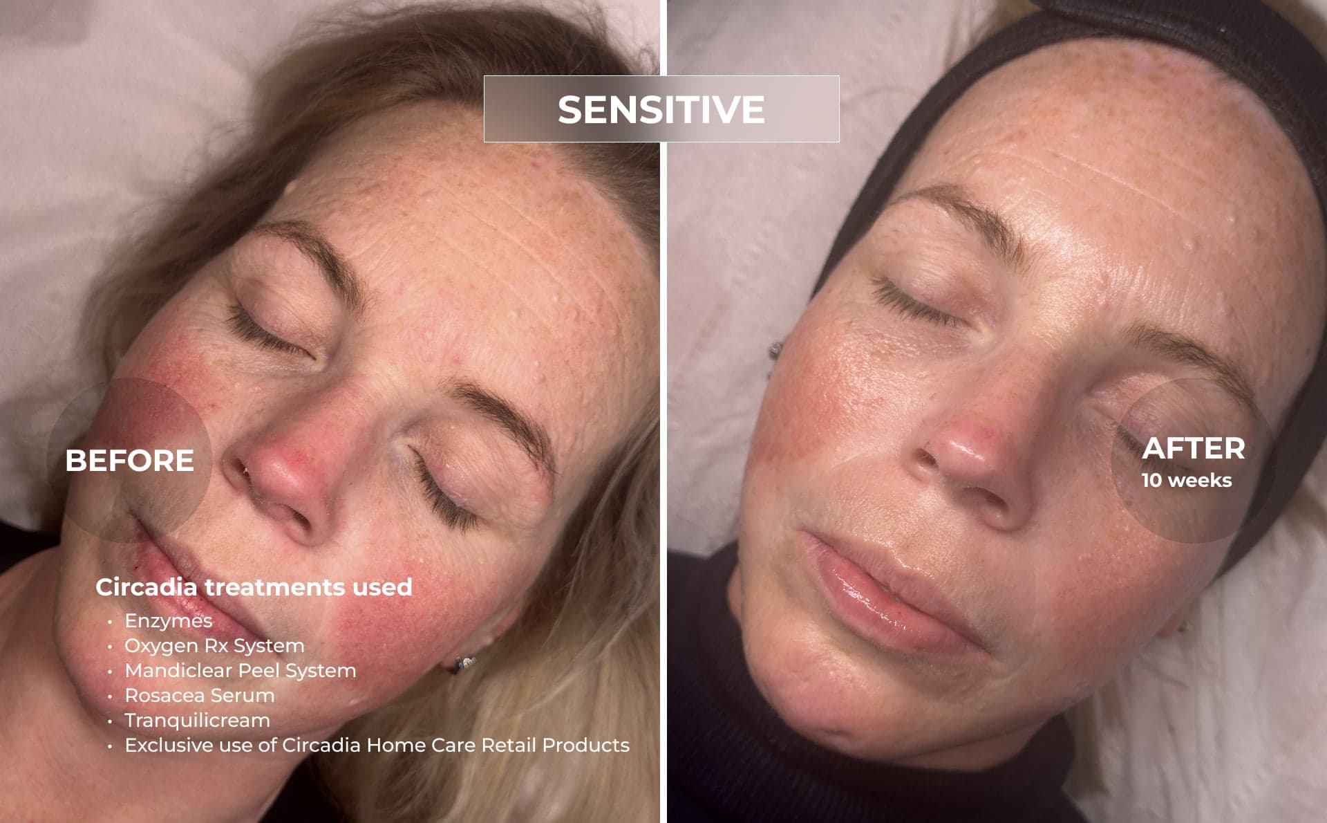 Circadia clinical before and after for Sensitive Skin & Rosacea, using Oxygen Rx · Rosacea Serum · Tranquilicream, over 10 weeks